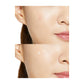 acne pads, acne treatment, cosrx pimple patch