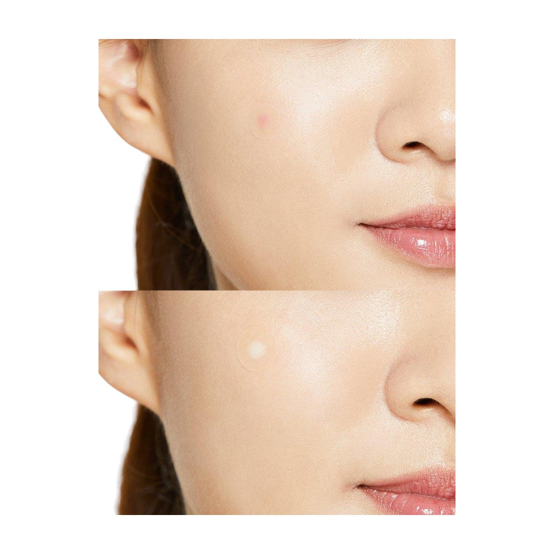 acne pads, acne treatment, cosrx pimple patch