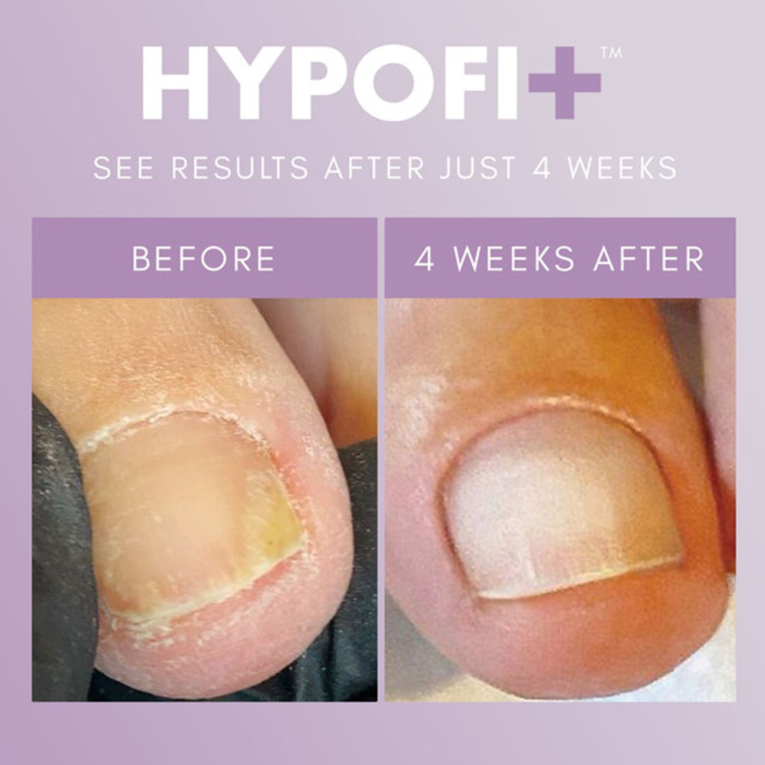 The GelBottle - Hypofix Bundle