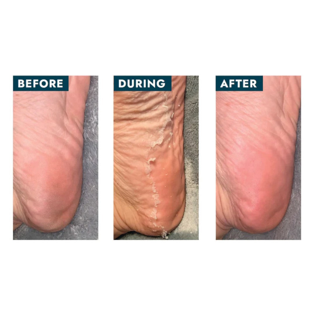 Voesh Peeling Socks W/ Plant-Based Aha + 17 Botanical Extracts