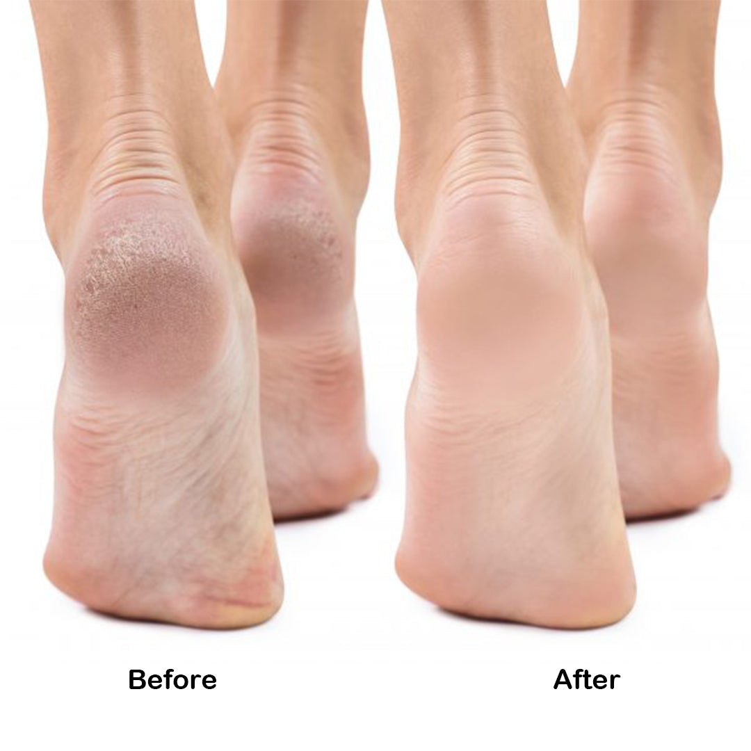 Footlogix 3+ Cracked Heel Formula 4.23oz, footlogics, KVG, footlogix cracked heel formula, footlogix cracked heel​, white heels